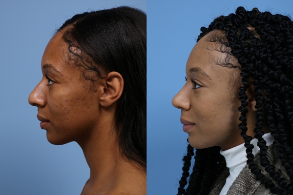 1. Rhinoplasty