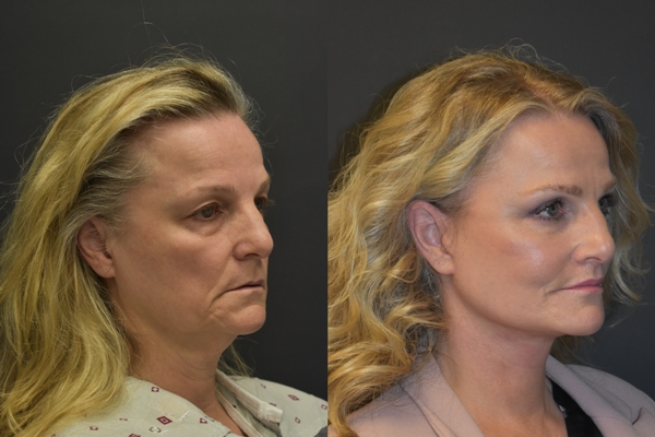 10. L&P Signature Facelift & Neck Lift - 3