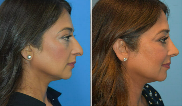 2. Rhinoplasty & Fat Transfer B&A side