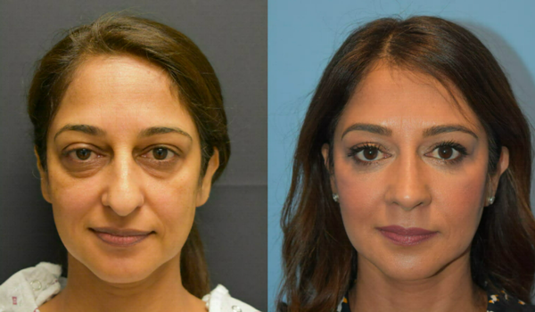 2A. Before and After_ Rhinoplasty and fat transfer