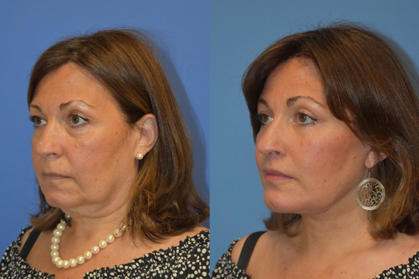3. L&P Signature face & necklift.Lift